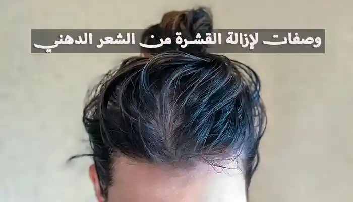 5 وصفات لإزالة القشرة من الشعر الدهني نهائياً 1 5 وصفات لإزالة القشرة من الشعر الدهني نهائياً