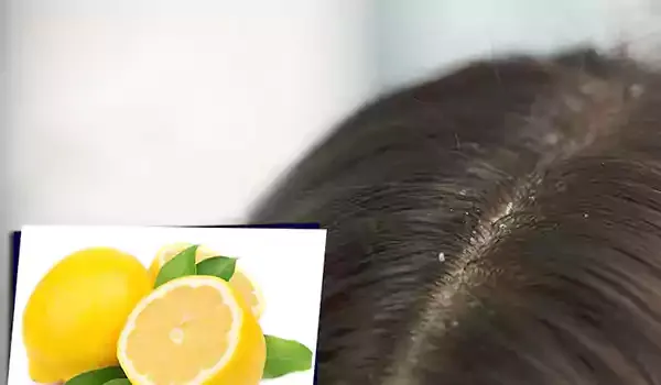 علاج القمل بالليمون نهائياً - 4 طرق سهلة سريعة المفعول 2 فوائد الليمون لفروة الرأس