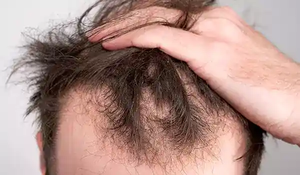 أنواع تساقط الشعر - مكتوبة