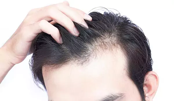الفيتامينات التي تسبب تساقط الشعر عن نقصها