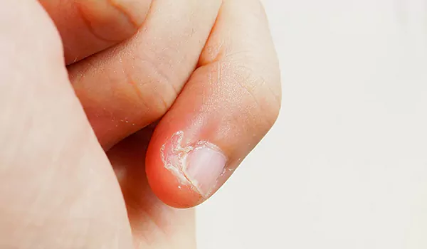نصائح لعلاج تقشر جلد الأصابع حول الأظافر 
