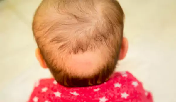 أسباب تساقط الشعر عند البنات الصغار وكيفية علاجه أسباب طبية لتساقط الشعر عند البنات الصغار - مكتوبة