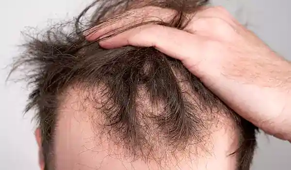 علاج تساقط الشعر بـ 60 حل سحري طبيعي حسب نوع شعرك! 4 أنواع تساقط الشعر - مكتوبة