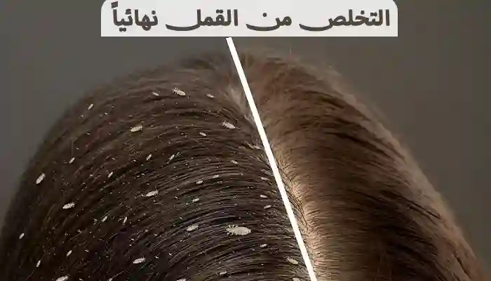 التخلص من القمل نهائياً في المنزل بـ 10 علاجات سهلة 1 التخلص من القمل نهائياً في المنزل بـ 10 علاجات سهلة