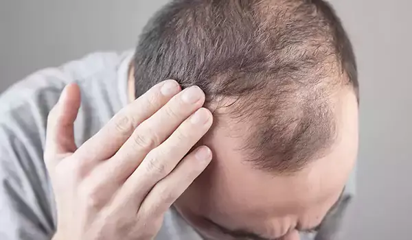 لماذا يتساقط الشعر فجأة؟ 10 أسباب محتملة 5 ماذا تفعل اذا تساقط شعرك فجأة - مكتوبة