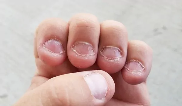 10 أسباب تقشر جلد الأصابع حول الأظافر مع علاج كل سبب 3 مص أو قضم الأصابع