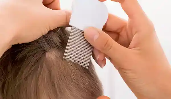 التخلص من القمل نهائياً في المنزل بـ 10 علاجات سهلة 3 نصائح الخبراء للتخلص من القمل بسرعة