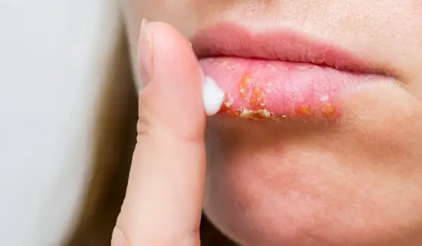 علاج تشقق الشفاه في الشتاء في المنزل