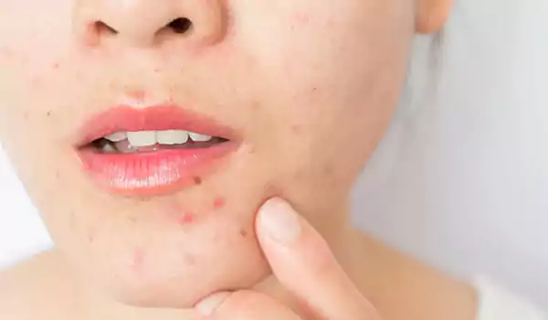 ماسكات لإزالة الحبوب من البشرة الدهنية - مكتوبة