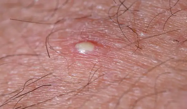 أسباب ظهور حبوب تحت الجلد في المناطق الحساسة ؟