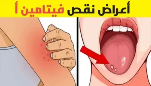 أعراض نقص فيتامين أ