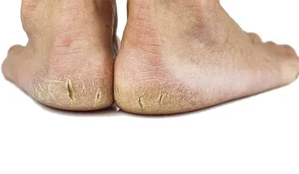 العناية بالقدمين المتشققة بالمنزل - 5 طرق مجربة طرق علاج تشققات الكعبين الشديدة