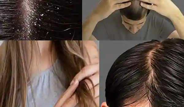 ماسكات لعلاج مشاكل الشعر في البيت 