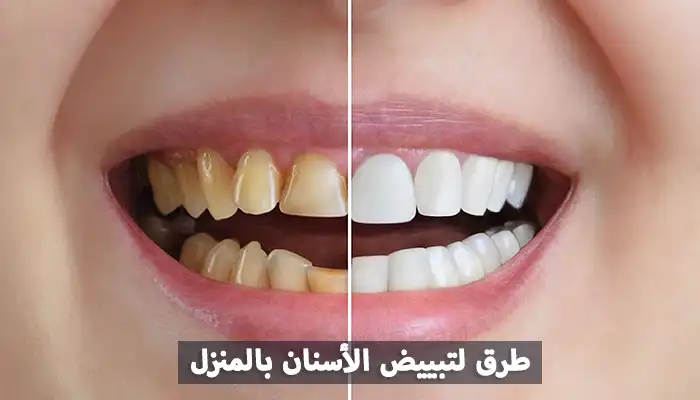 4 علاجات لتبييض الأسنان بسرعة في المنزل