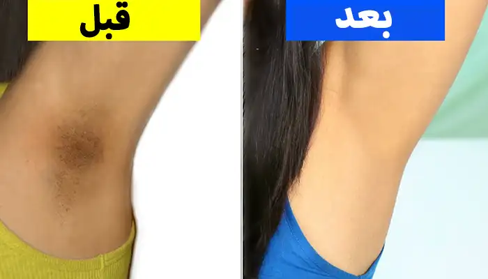 التخلص من سواد الإبط في أسبوع - 10 وصفات طبيعية