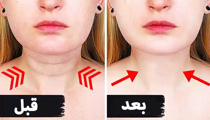 طريقة علاج خطوط الرقبة في المنزل طبيعياً