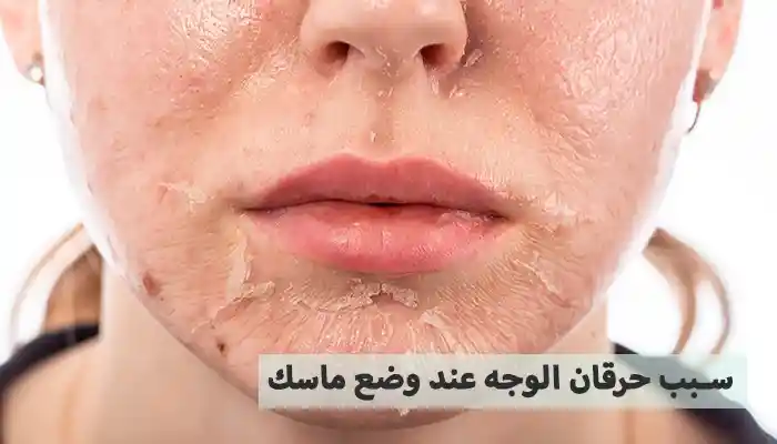 سبب حرقان الوجه عند وضع ماسك 7 أخطاء شائعة