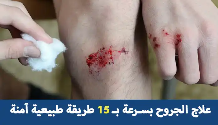 علاج الجروح بسرعة بـ 15 طريقة طبيعية آمنة