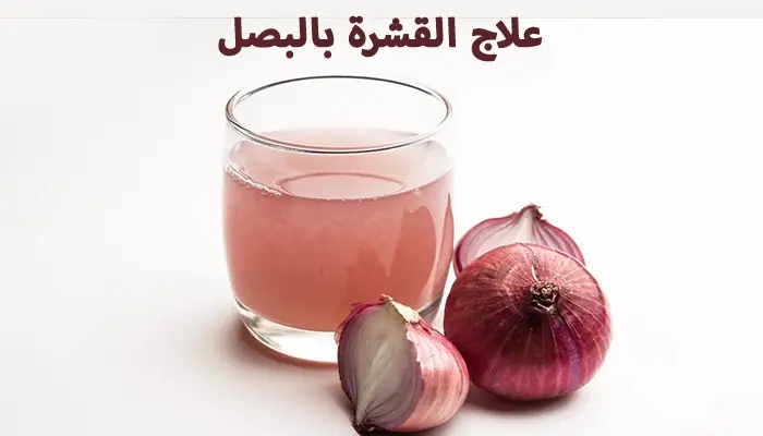 علاج القشرة بالبصل بـ5 طرق طبيعية لإزالتها نهائياً