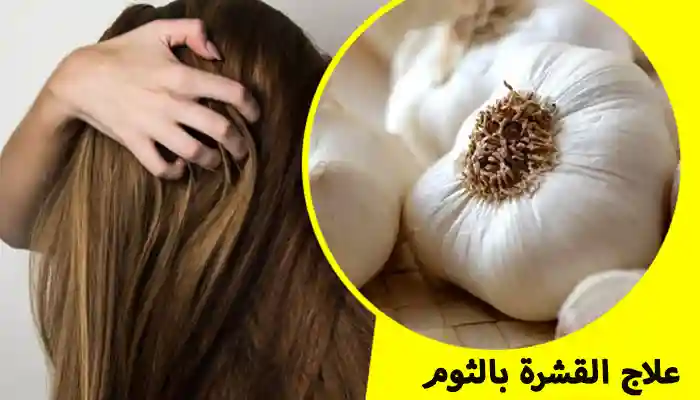 علاج القشرة بالثوم: أفضل الوصفات الطبيعية المجربة