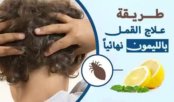 علاج القمل بالليمون نهائياً - 4 طرق سهلة سريعة المفعول 1 علاج القمل بالليمون نهائياً – 4 طرق سهلة سريعة المفعول