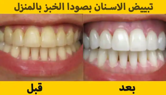 تبييض الاسنان بصودا الخبز 6 طرق منزلية مبهرة وآمنة