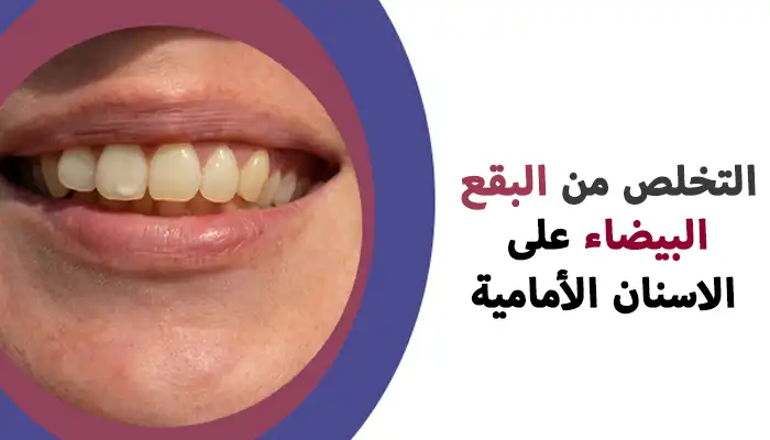 كيفية التخلص من البقع البيضاء على الاسنان الأمامية طبيعياً
