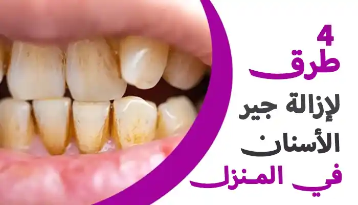 4 طرق لإزالة جير الأسنان بالمنزل بالطب البديل 1 4 طرق لإزالة جير الأسنان بالمنزل بالطب البديل