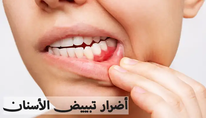 أضرار تبييض الأسنان على صحة الأسنان واللثة أضرار تبييض الأسنان على صحة الأسنان واللثة