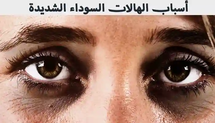 أبرز أسباب الهالات السوداء الشديدة والوقاية منها 1 أبرز أسباب الهالات السوداء الشديدة والوقاية منها