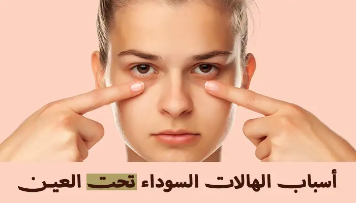 أسباب الهالات السوداء تحت العين وعلاجها طبيعياً 1 أسباب الهالات السوداء تحت العين وعلاجها طبيعياً