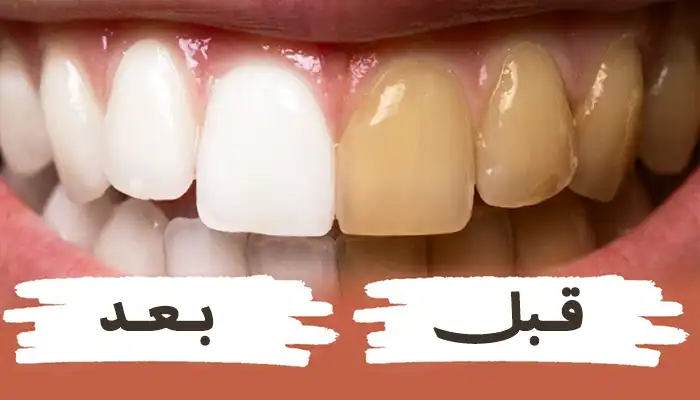 طريقة تبييض الأسنان طبيعياً بالمنزل 1 طريقة تبييض الأسنان طبيعياً بالمنزل
