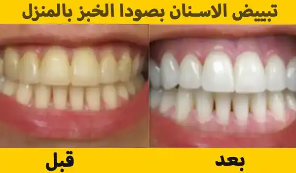 طريقة تبييض الأسنان طبيعياً بالمنزل 2 طريقة تبييض الأسنان طبيعياً بصودا الخبز والماء