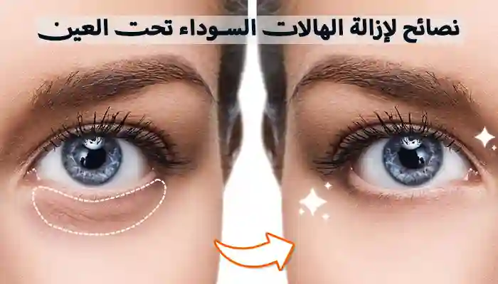 نصائح لإزالة الهالات السوداء تحت العين 1 نصائح لإزالة الهالات السوداء تحت العين