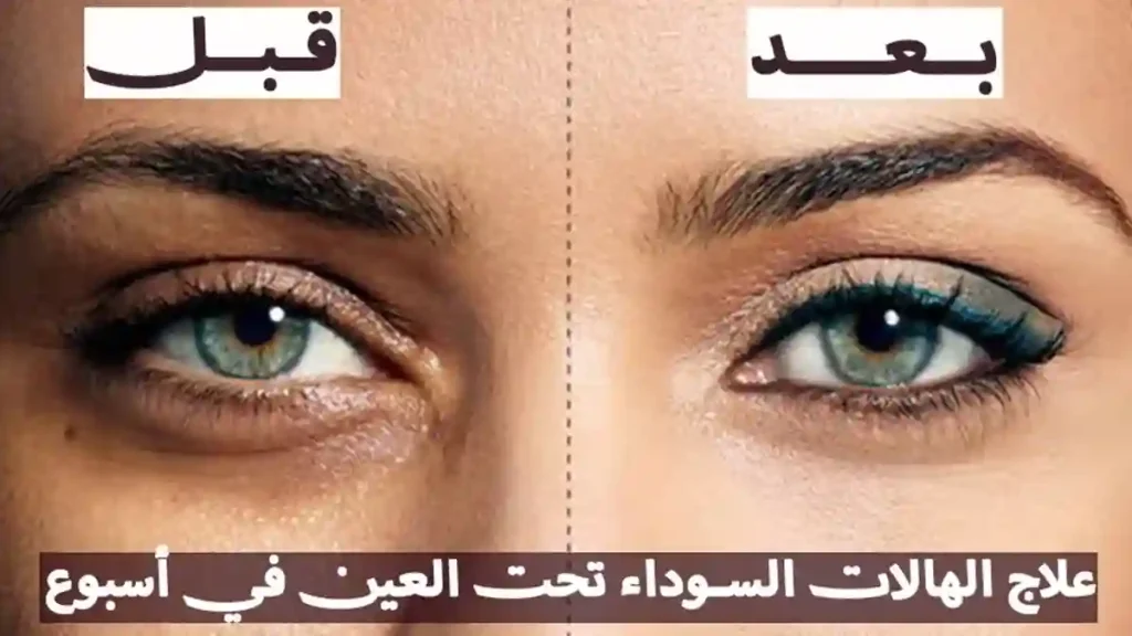 علاج الهالات السوداء تحت العين في أسبوع – 12 طريقة مجربة 3 علاج الهالات السوداء تحت العين في أسبوع – 12 طريقة مجرب
